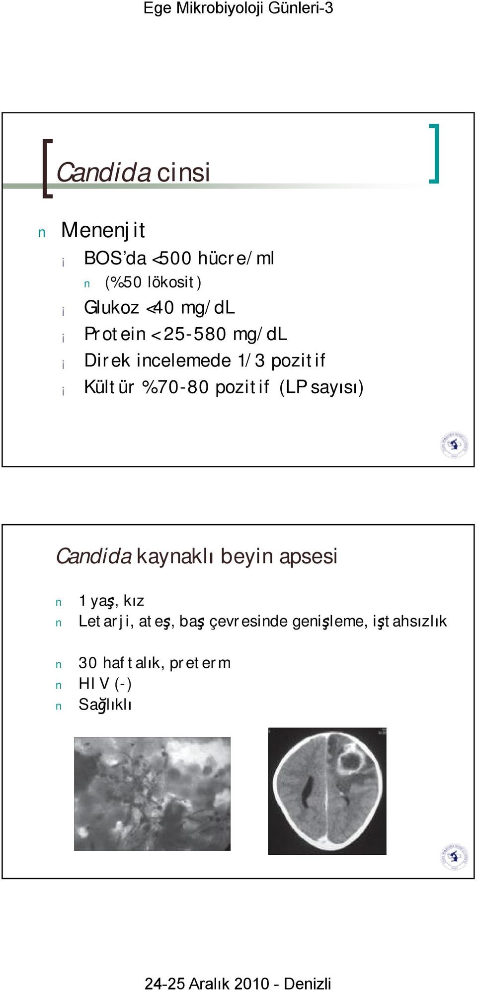 pozitif (LP sayısı) Candida kaynaklı beyin apsesi 1 yaş, kız Letarji,