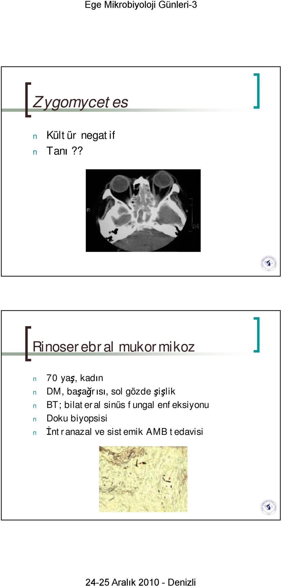 başağrısı, sol gözde şişlik BT; bilateral sinüs