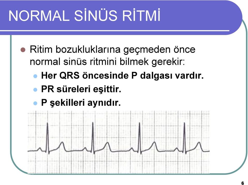 gerekir: Her QRS öncesinde P dalgası