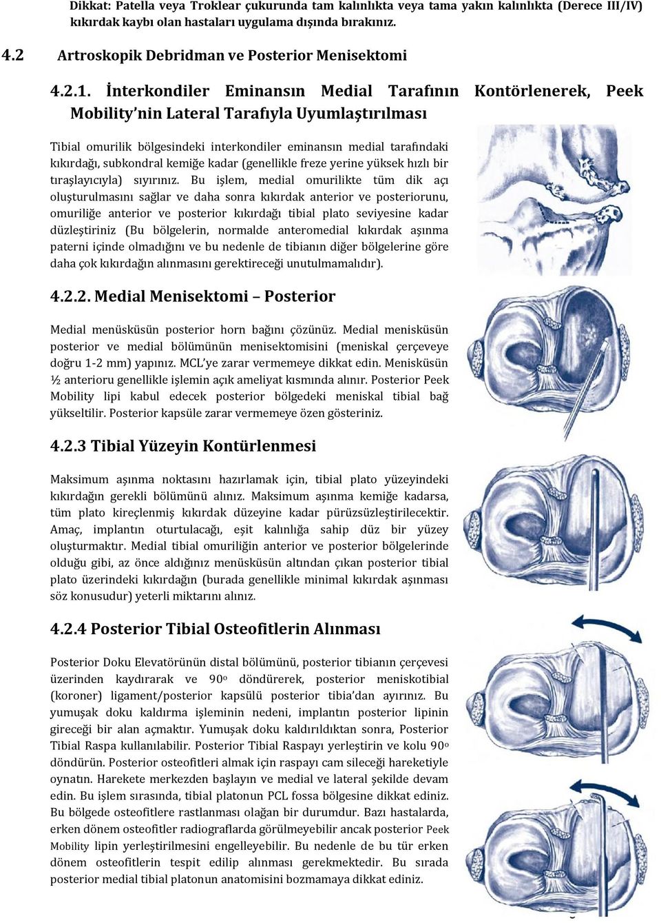 İnterkondiler Eminansın Medial Tarafının Kontörlenerek, Peek Mobility nin Lateral Tarafıyla Uyumlaştırılması Tibial omurilik bölgesindeki interkondiler eminansın medial tarafındaki kıkırdağı,