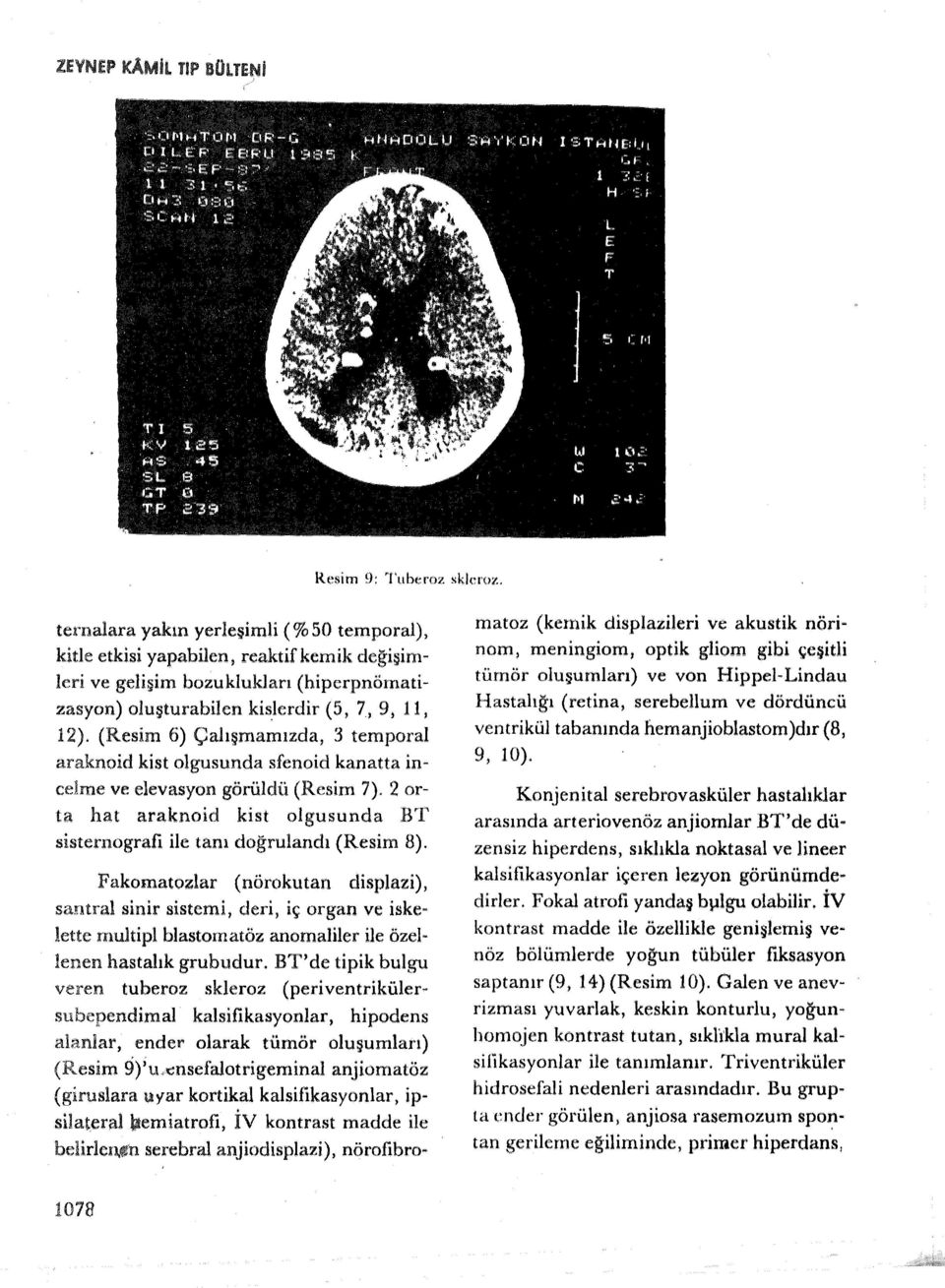 (Resim 6) Çalışmamızda, 3 temporal araknoid kist olgusunda sfenoid kanatta incelme ve elevasyon görüldü (Resim 7). 2 orta hat araknoid kist olgusunda BT sisternografi ile tanı doğrulandı (Resim 8).