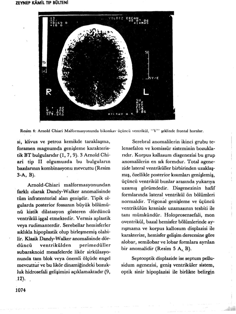 3 Arnold Chiari tip il olgumuzda bu bulguların butlarının kombinasyonu mevcuttu (Resim 3-A, B).