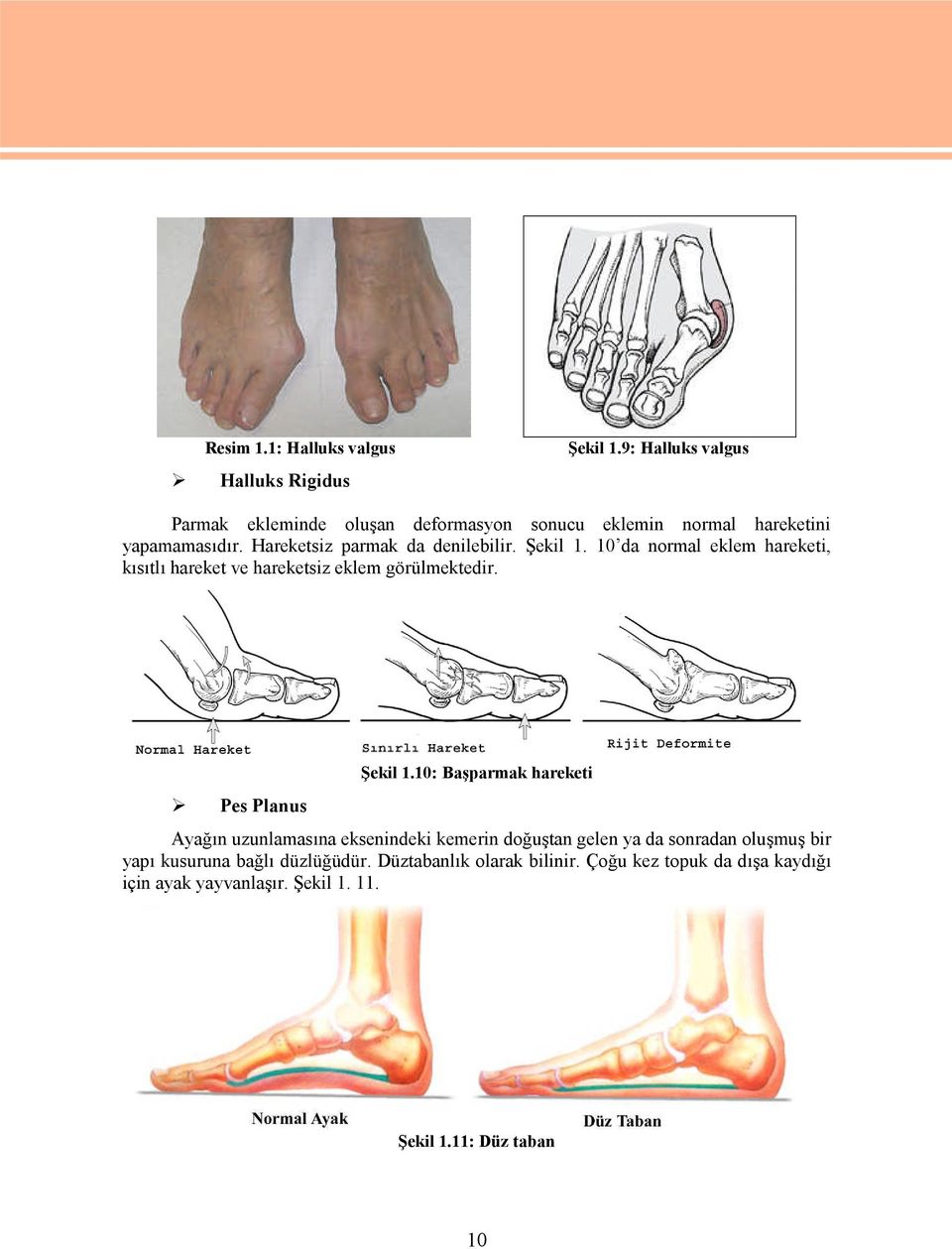 Şekil 1. 10 da normal eklem hareketi, kısıtlı hareket ve hareketsiz eklem görülmektedir. Pes Planus Şekil 1.