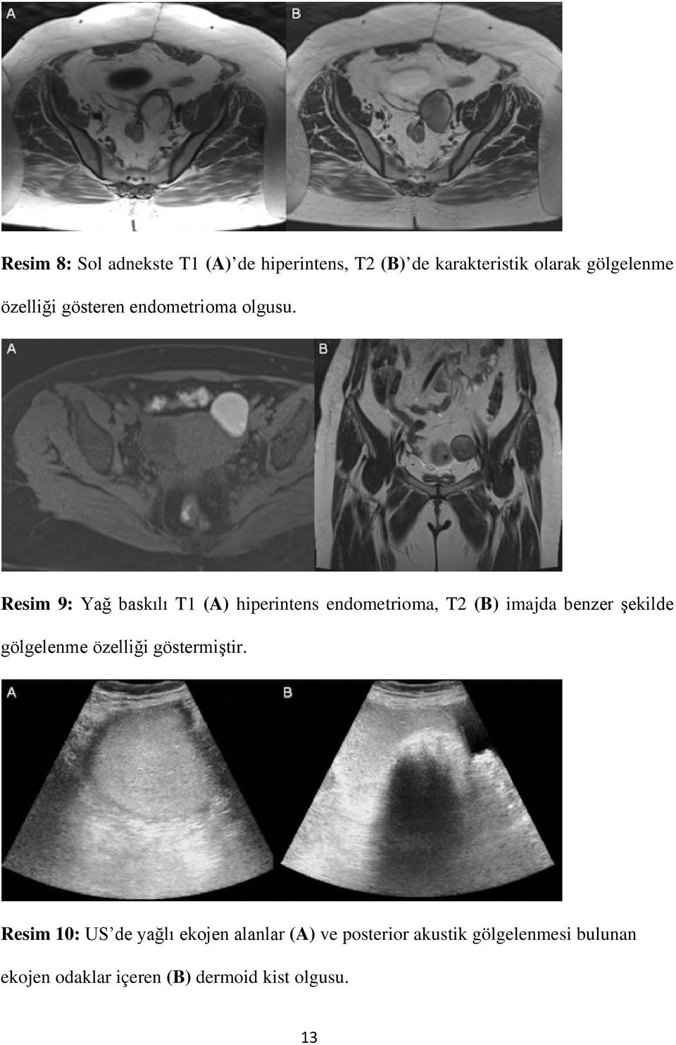 Resim 9: Yağ baskılı T1 (A) hiperintens endometrioma, T2 (B) imajda benzer şekilde gölgelenme