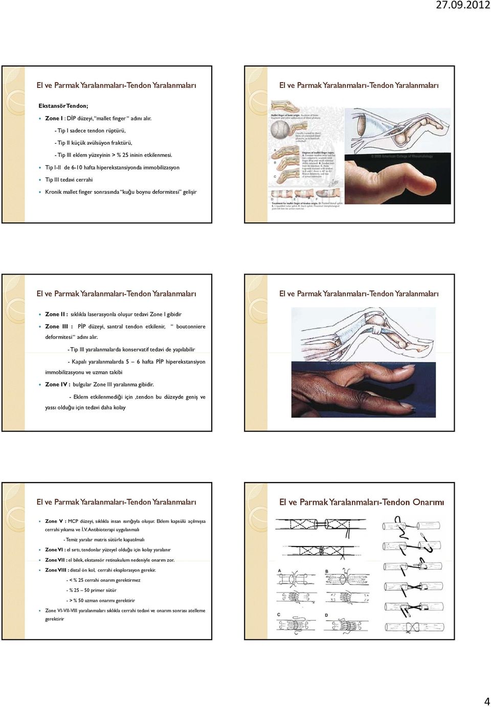 gibidir Zone III : PİP düzeyi, santral tendon etkilenir, boutonniere deformitesi adını alır.