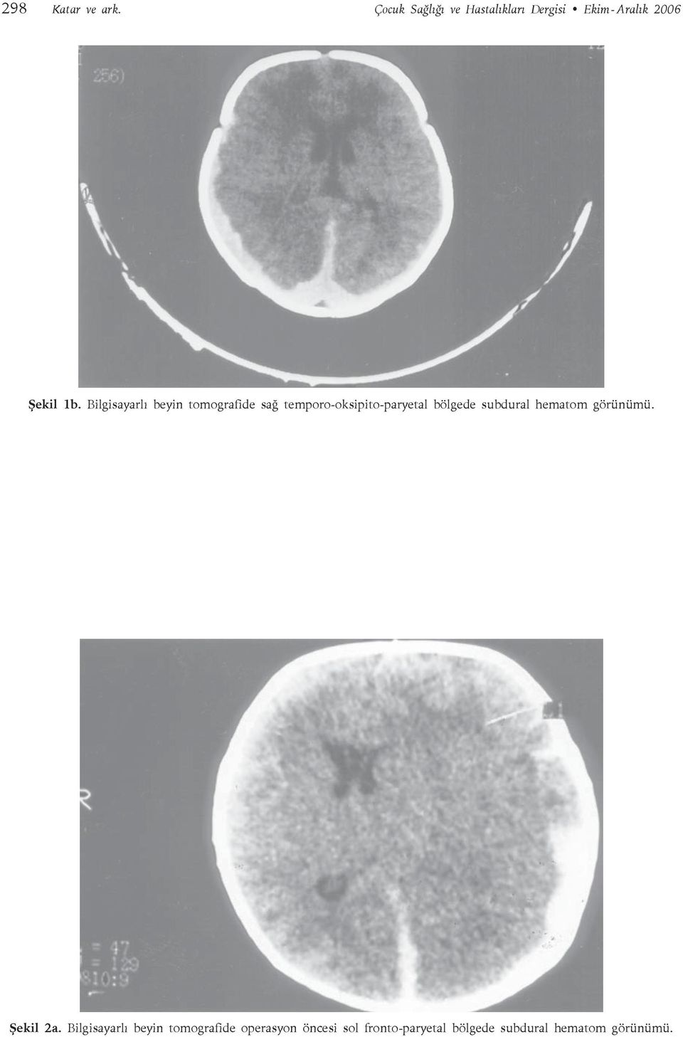 Bilgisayarlı beyin tomografide sağ temporo-oksipito-paryetal bölgede