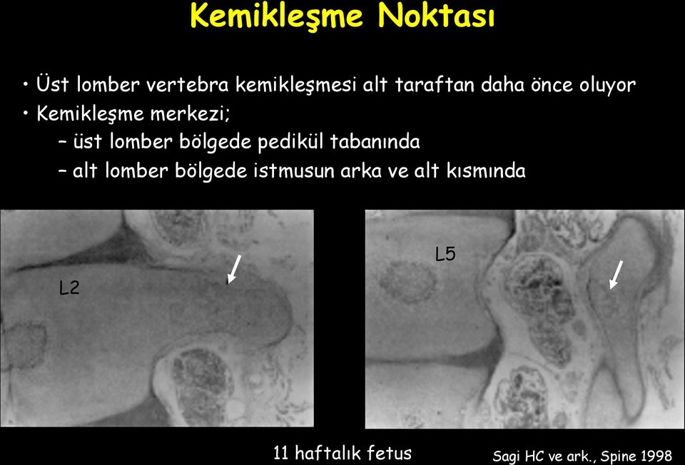 bölgede pedikül tabanında alt lomber bölgede istmusun arka