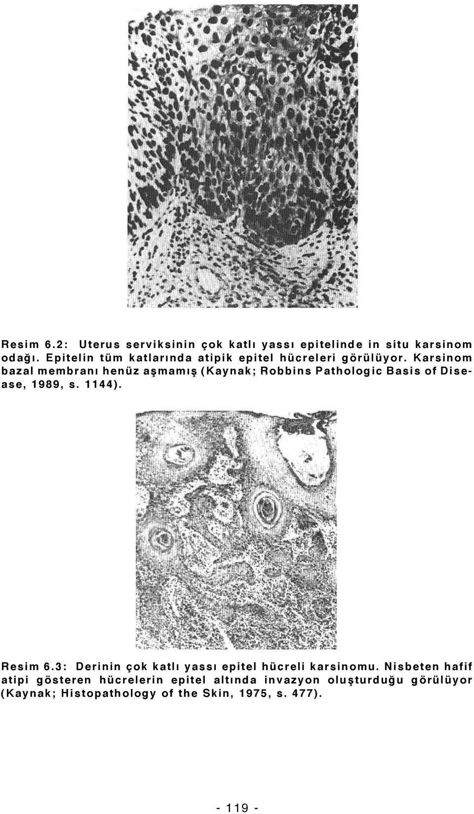 Karsinom bazal membranı henüz aşmamış (Kaynak; Robbins Pathologic Basis of Disease, 1989, s. 1144). Resim 6.