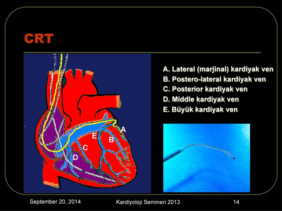 Posterior kardiyak ven D. Middle kardiyak ven E.