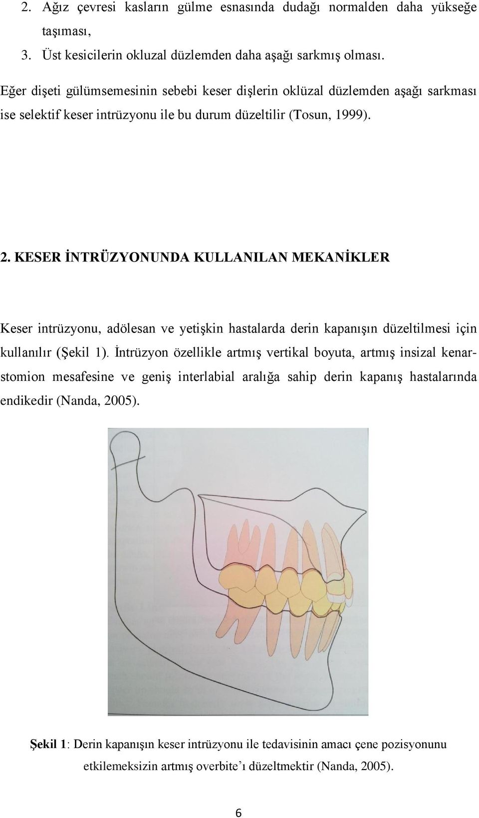 KESER İNTRÜZYONUNDA KULLANILAN MEKANİKLER Keser intrüzyonu, adölesan ve yetiģkin hastalarda derin kapanıģın düzeltilmesi için kullanılır (ġekil 1).