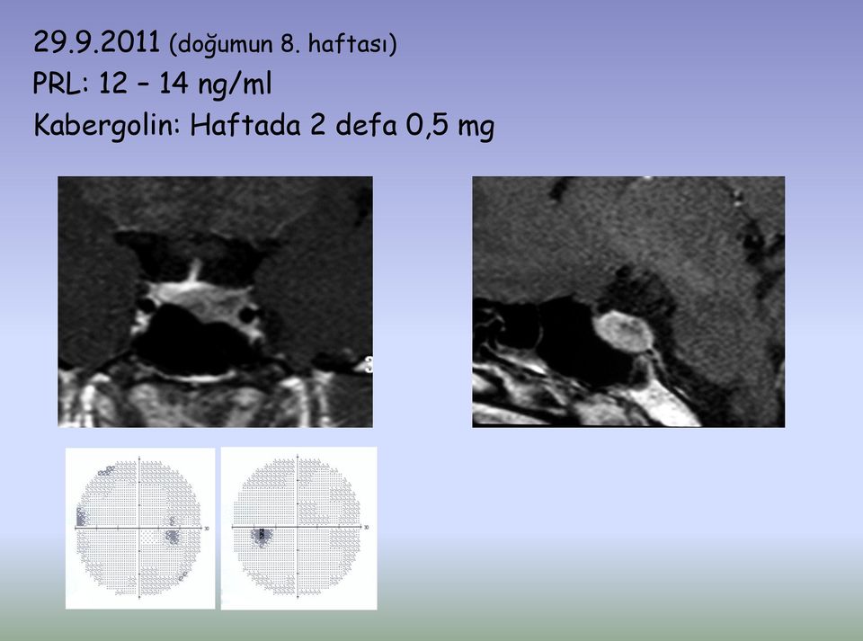 ng/ml Kabergolin: