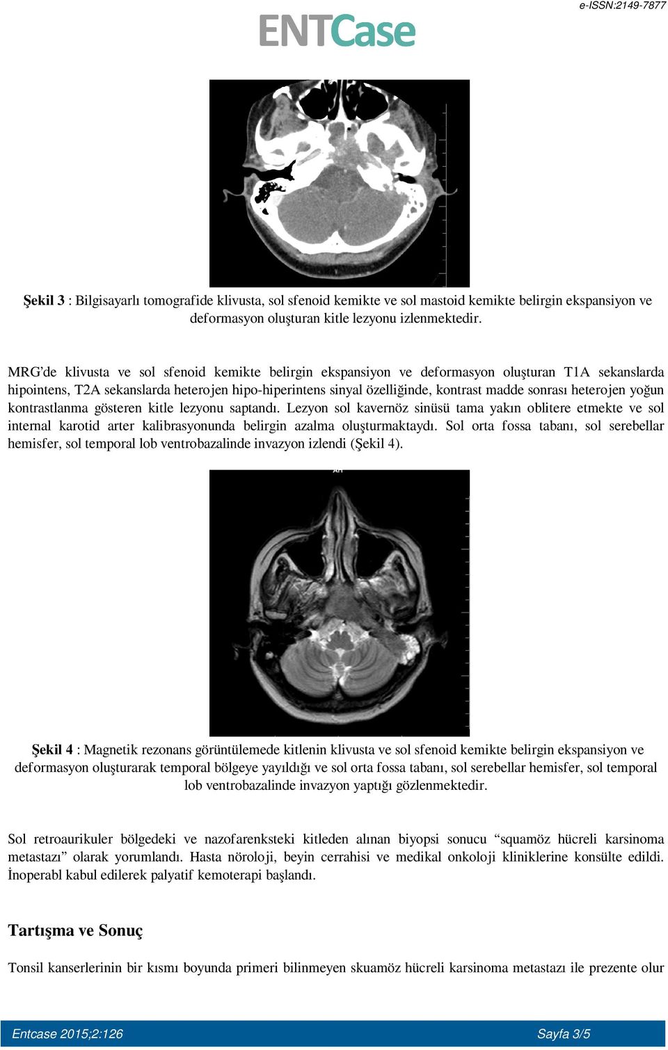 heterojen yoğun kontrastlanma gösteren kitle lezyonu saptandı. Lezyon sol kavernöz sinüsü tama yakın oblitere etmekte ve sol internal karotid arter kalibrasyonunda belirgin azalma oluşturmaktaydı.