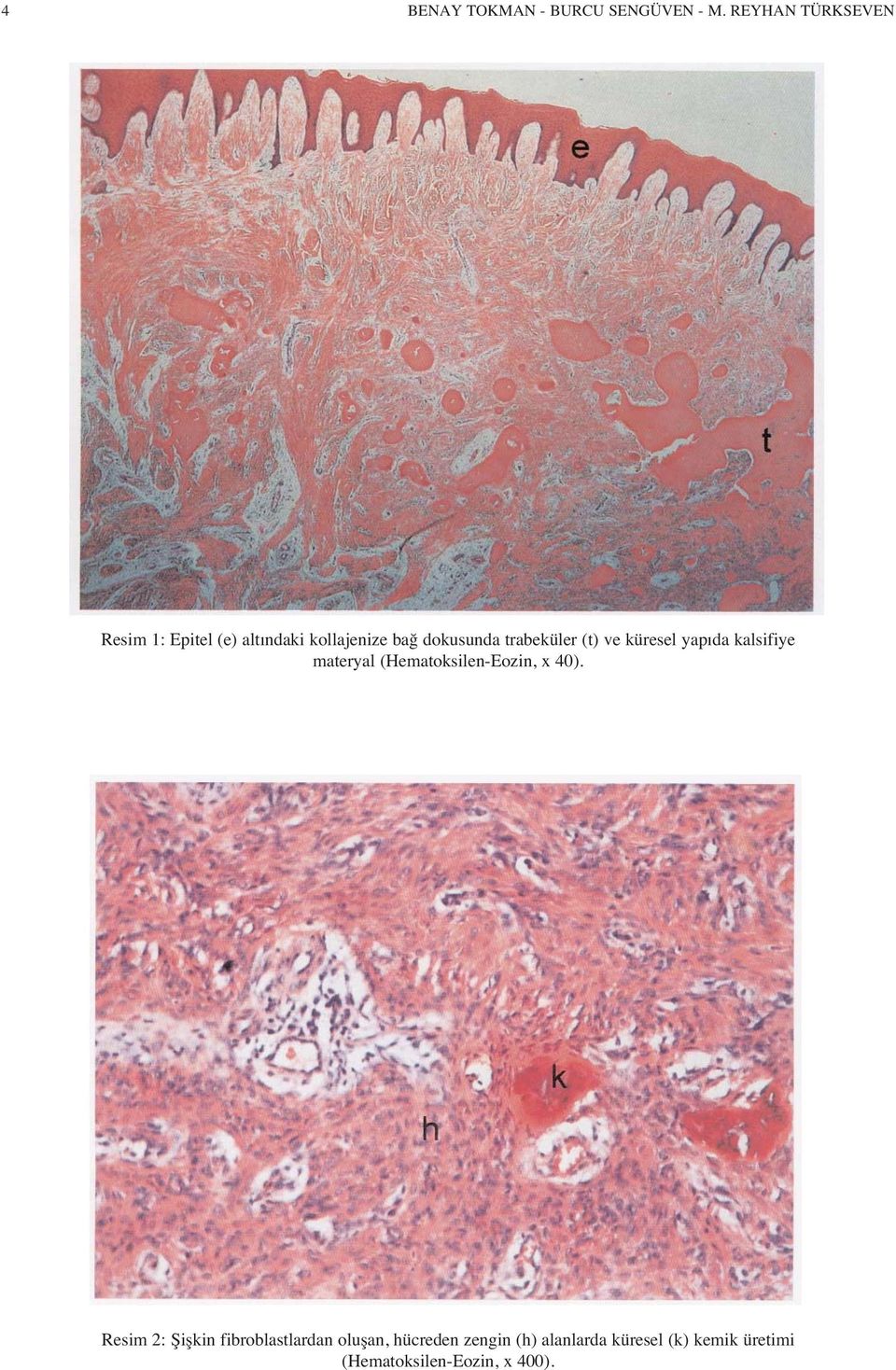 trabeküler (t) ve küresel yap da kalsifiye materyal (Hematoksilen-Eozin, x 40).