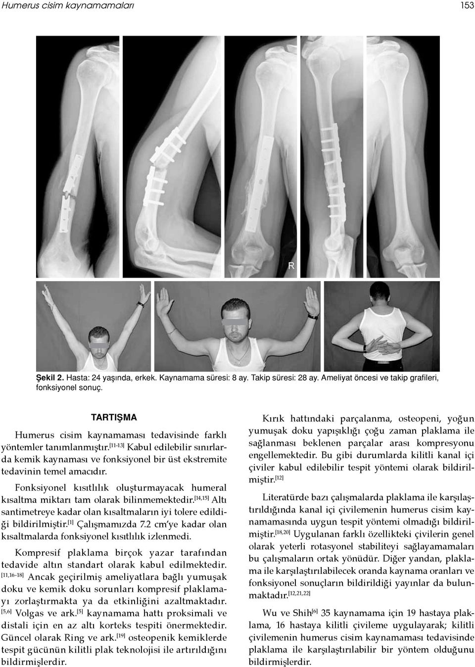 Fonksiyonel kısıtlılık oluşturmayacak humeral kısaltma miktarı tam olarak bilinmemektedir. [14,15] Altı santimetreye kadar olan kısaltmaların iyi tolere edildiği bildirilmiştir. [1] Çalışmamızda 7.