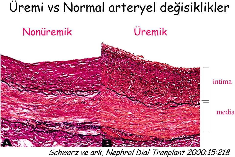 Üremik intima media Schwarz