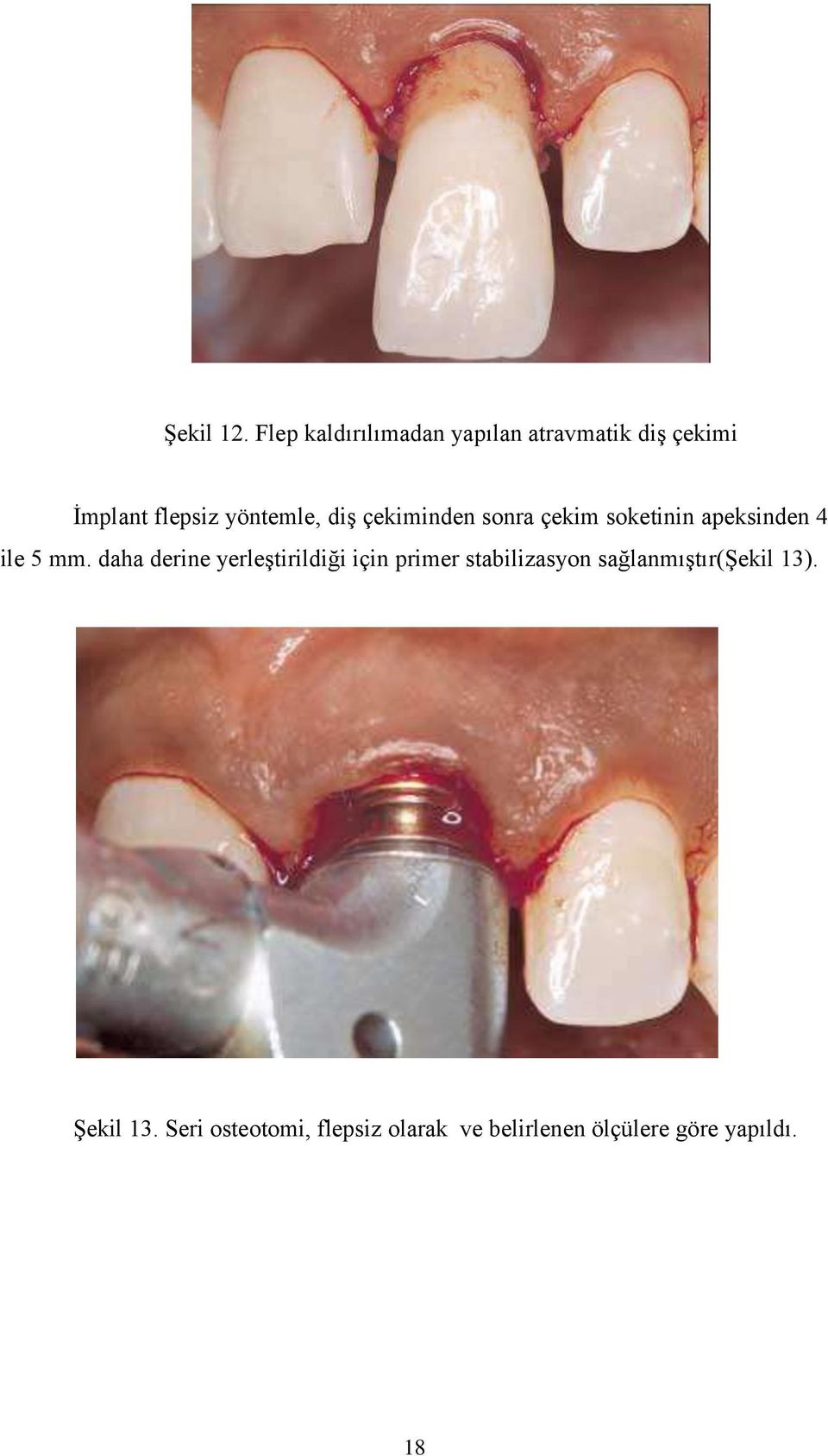 diş çekiminden sonra çekim soketinin apeksinden 4 ile 5 mm.