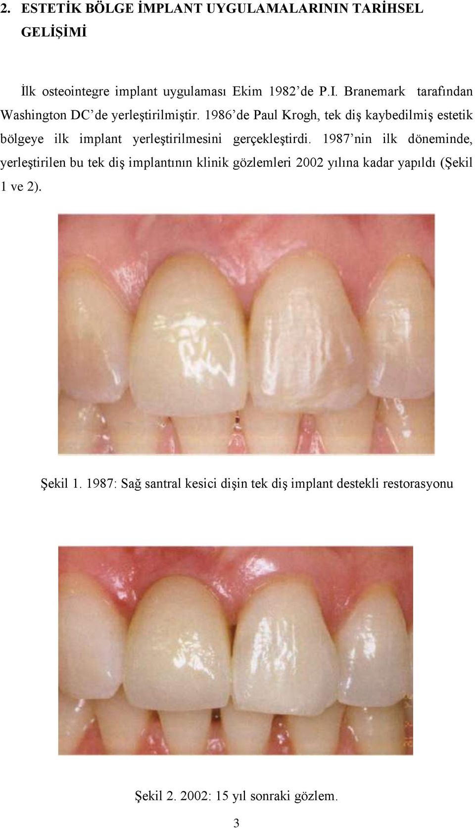 1987 nin ilk döneminde, yerleştirilen bu tek diş implantının klinik gözlemleri 2002 yılına kadar yapıldı (Şekil 1 ve 2).