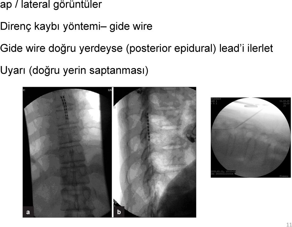 yerdeyse (posterior epidural) lead i