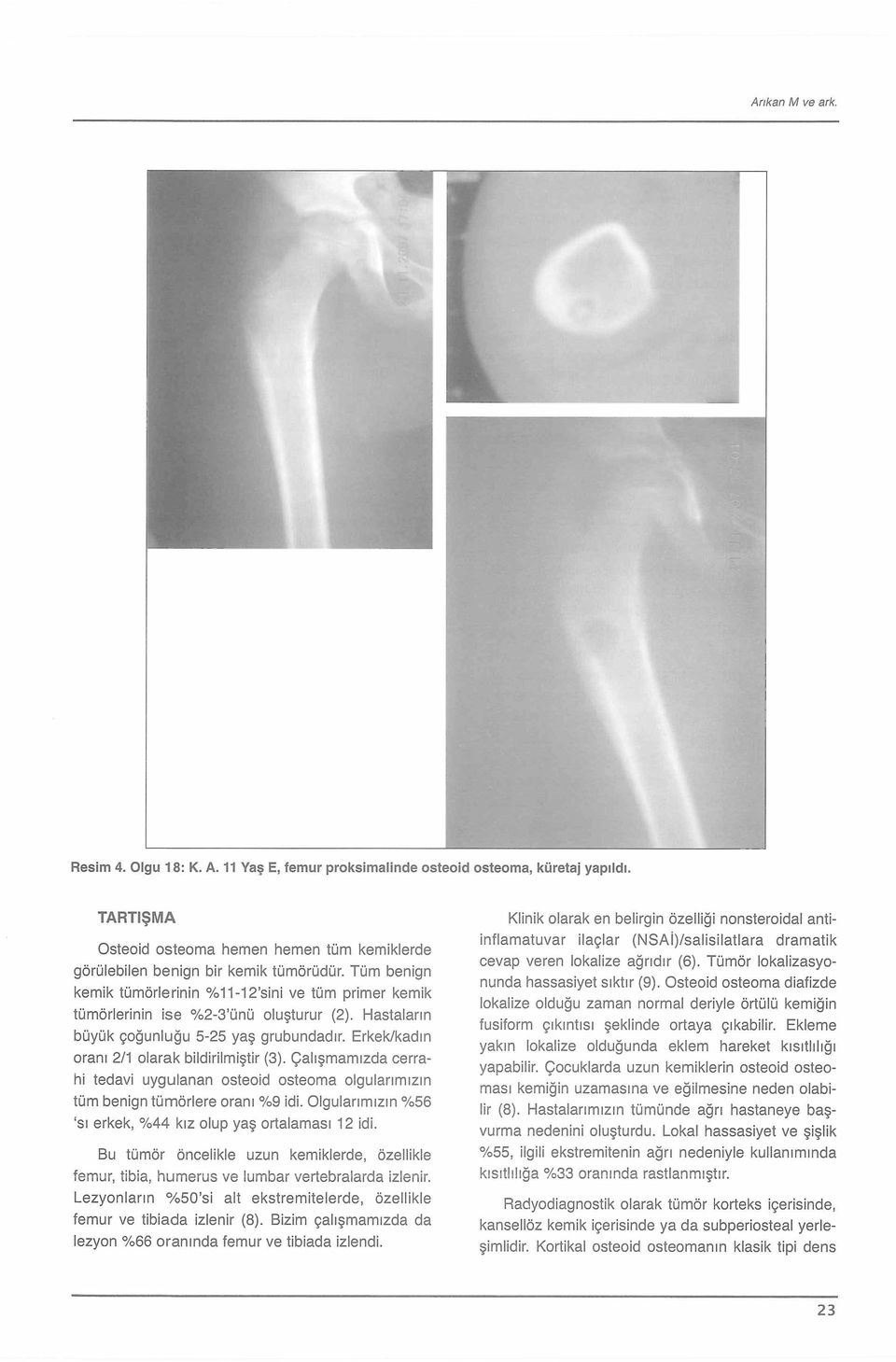 Çalışmamızda cerrahi tedavi uygulanan osteoid osteoma olgularımızın tüm benign tümörlere oranı %9 idi. Olgularımızın %56 sı erkek, %44 kız olup yaş ortalaması 12 idi.