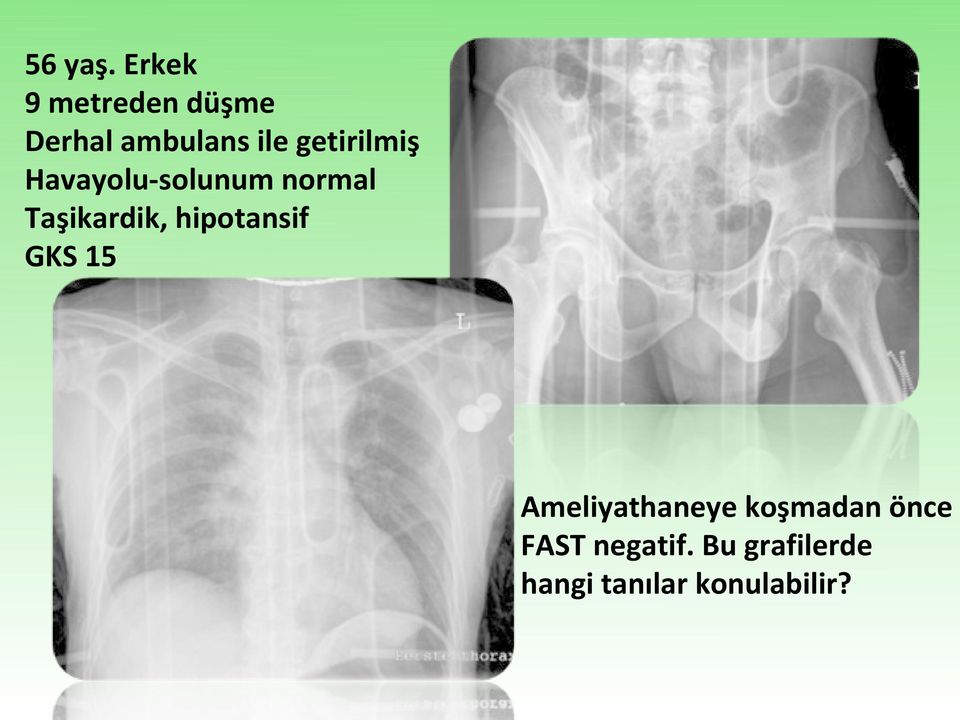 getirilmiş Havayolu-solunum normal Taşikardik,