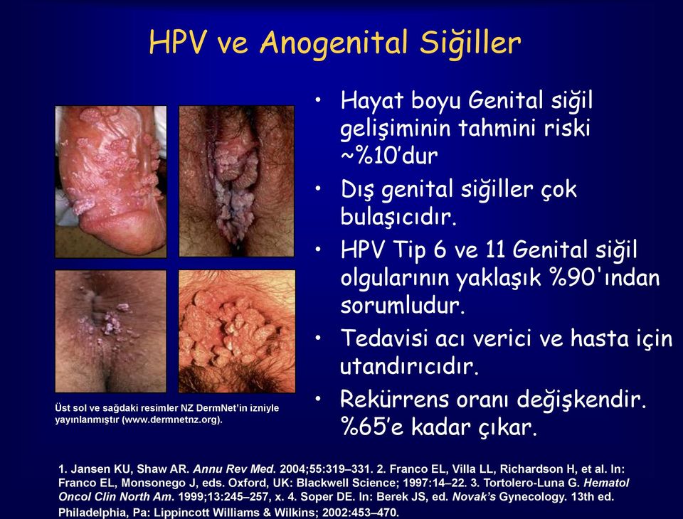 HPV ve Anogenital Siğiller Üst sol ve sağdaki resimler NZ DermNet in izniyle yayınlanmıştır (www.dermnetnz.org).