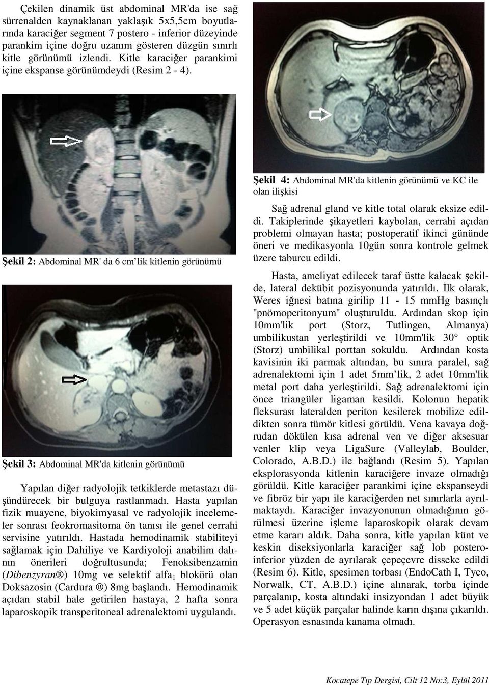 Şekil 2: Abdominal MR' da 6 cm lik kitlenin görünümü Şekil 3: Abdominal MR'da kitlenin görünümü Yapılan diğer radyolojik tetkiklerde metastazı düşündürecek bir bulguya rastlanmadı.