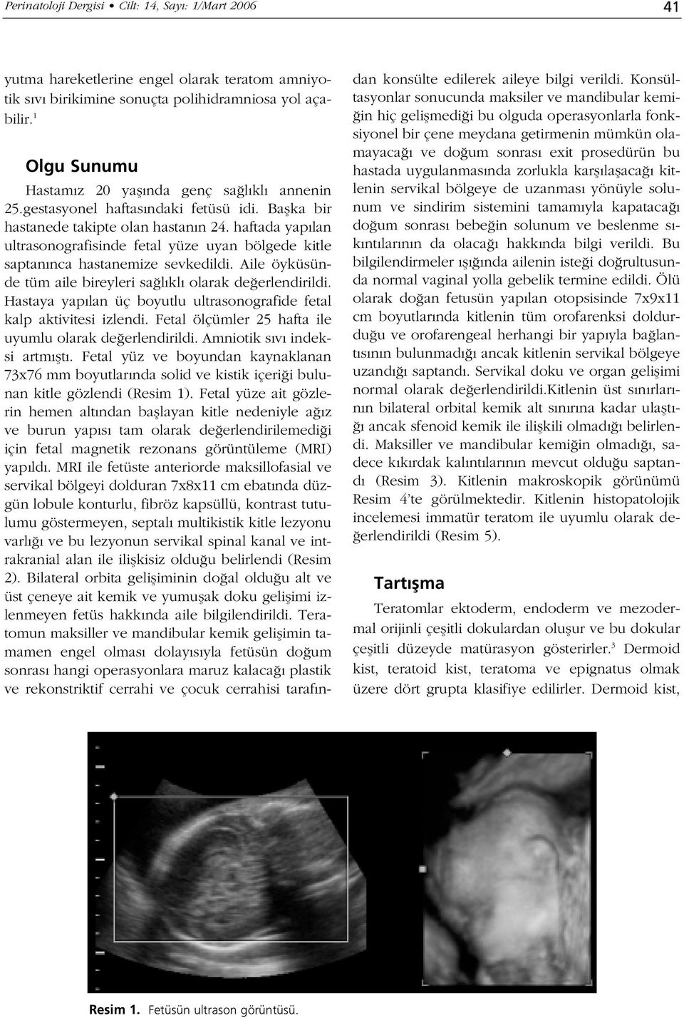 haftada yap lan ultrasonografisinde fetal yüze uyan bölgede kitle saptan nca hastanemize sevkedildi. Aile öyküsünde tüm aile bireyleri sa l kl olarak de erlendirildi.