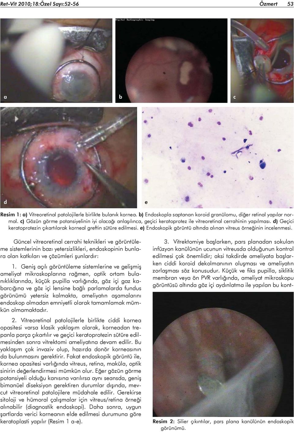 e) Endoskopik görüntü altında alınan vitreus örneğinin incelenmesi.