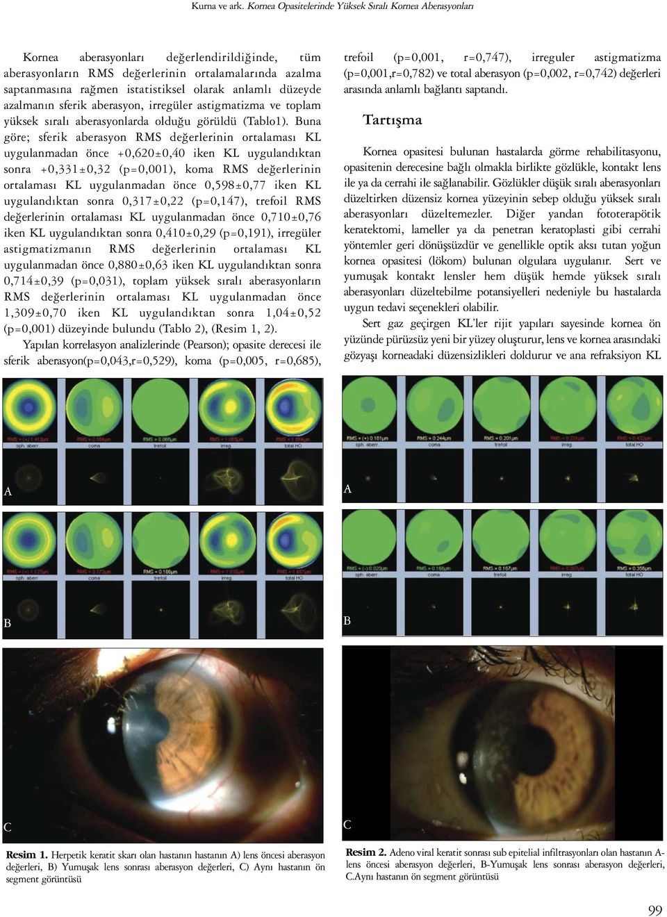 anlamlı düzeyde azalmanın sferik aberasyon, irregüler astigmatizma ve toplam yüksek sıralı aberasyonlarda olduğu görüldü (Tablo1).