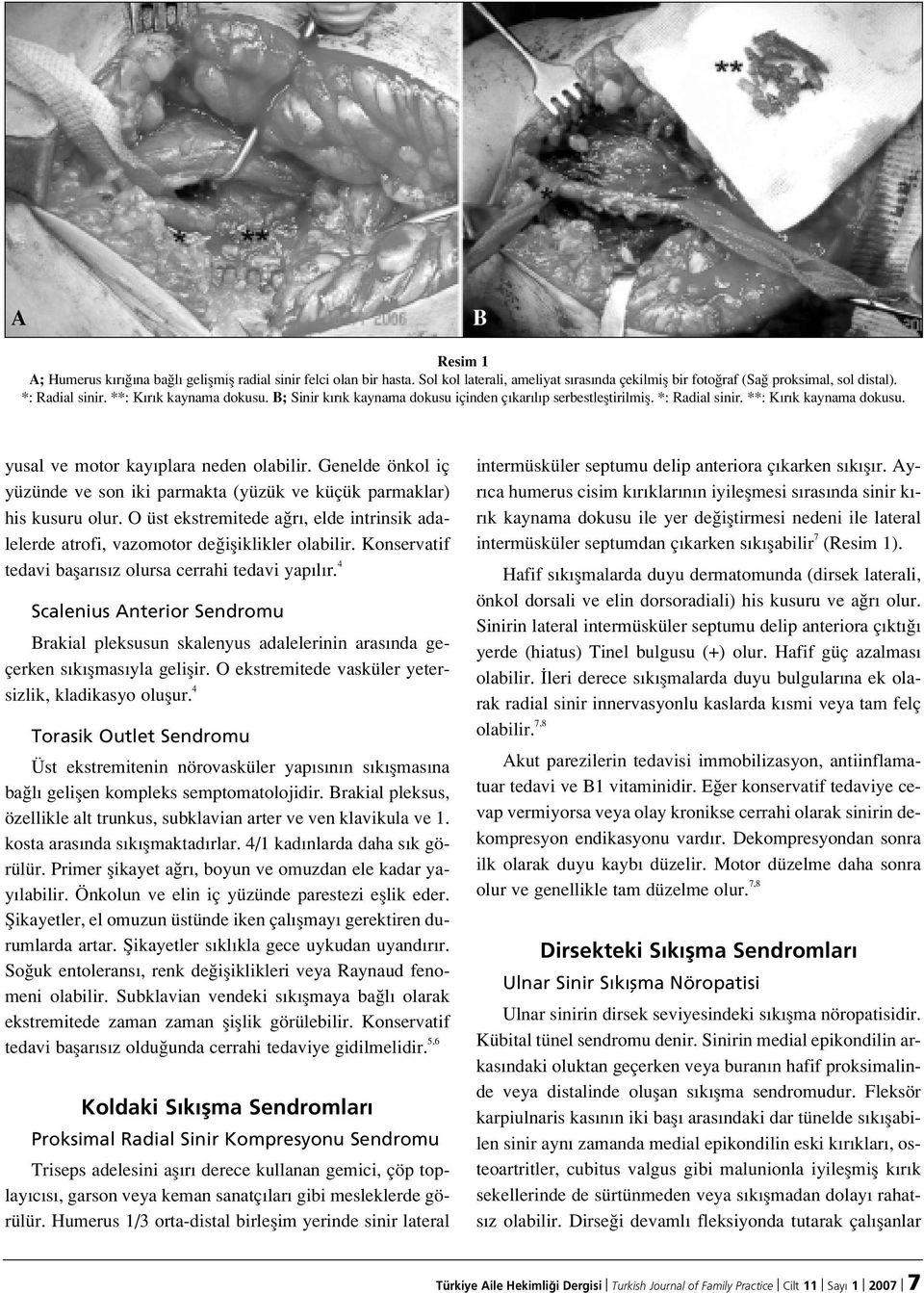 Genelde önkol iç yüzünde ve son iki parmakta (yüzük ve küçük parmaklar) his kusuru olur. O üst ekstremitede a r, elde intrinsik adalelerde atrofi, vazomotor de ifliklikler olabilir.