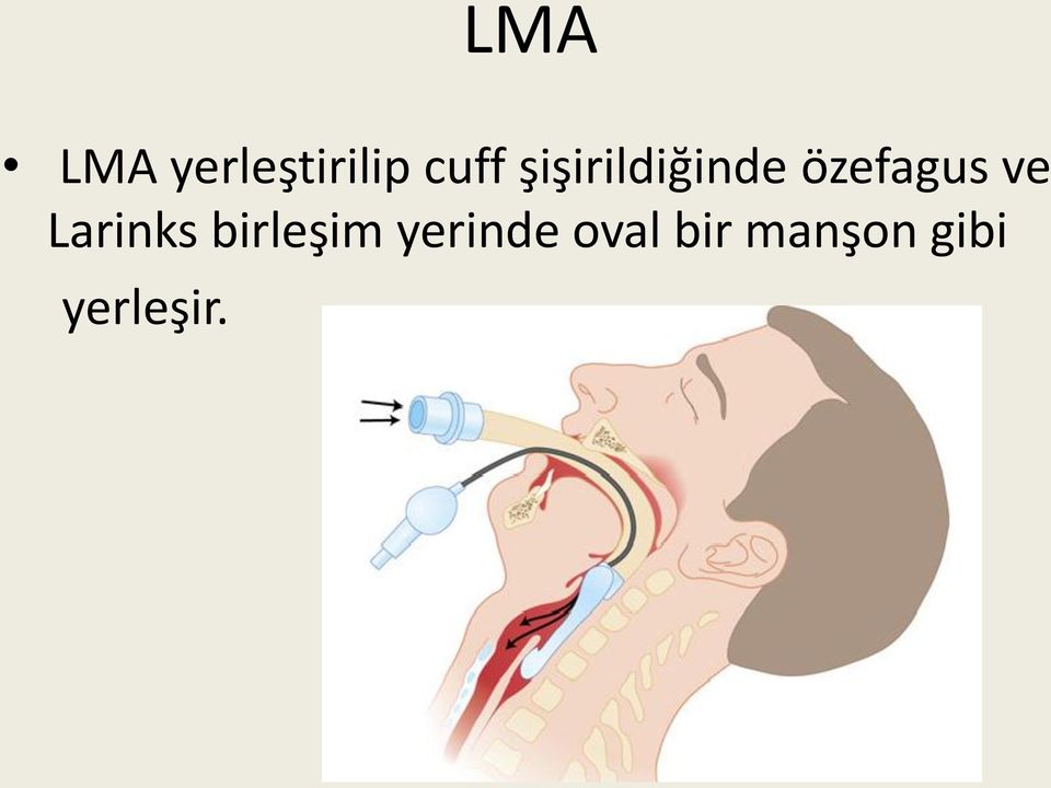 Larinks birleşim yerinde