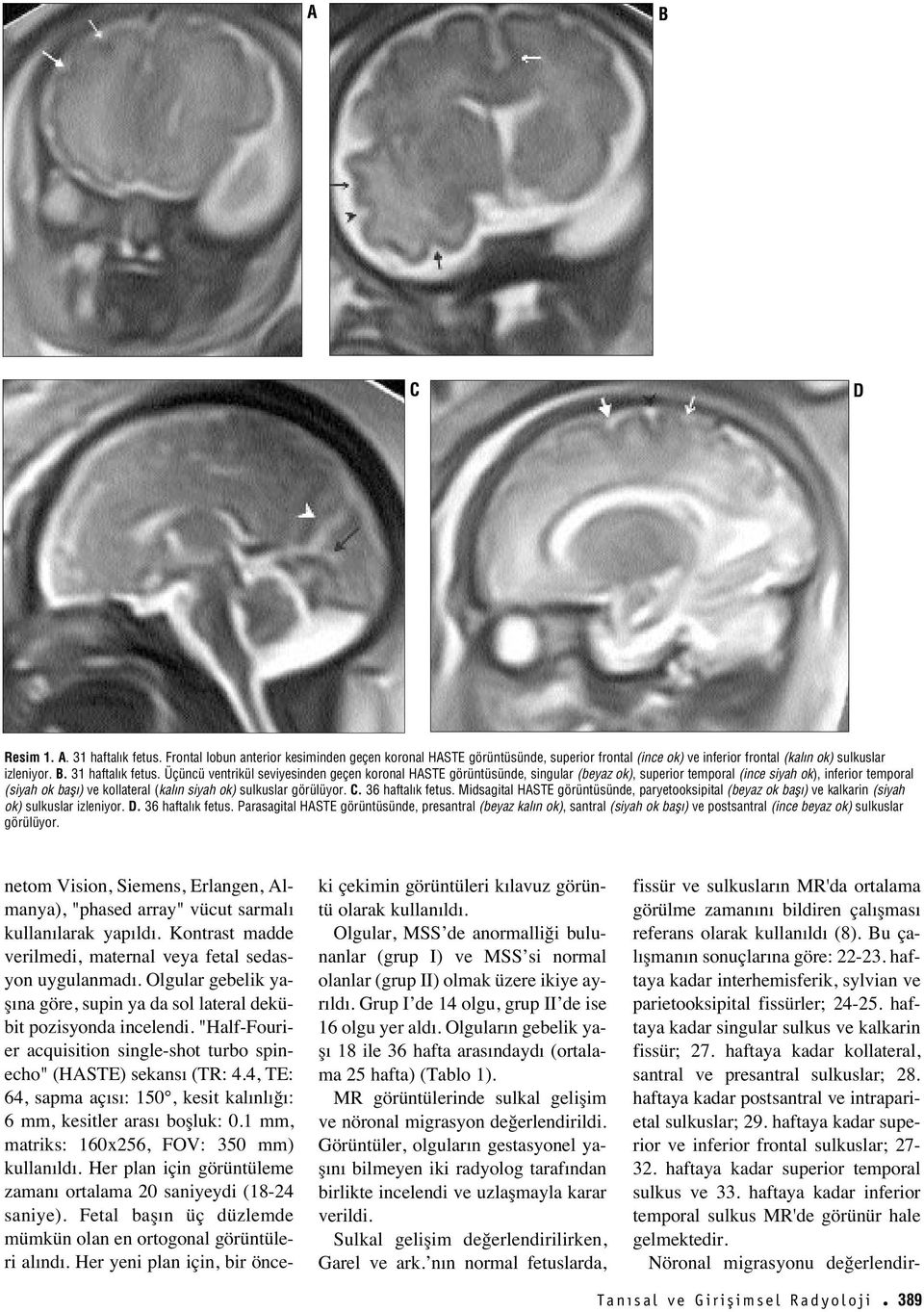 Üçüncü ventrikül seviyesinden geçen koronal HASTE görüntüsünde, singular (beyaz ok), superior temporal (ince siyah ok), inferior temporal (siyah ok bafl ) ve kollateral (kal n siyah ok) sulkuslar