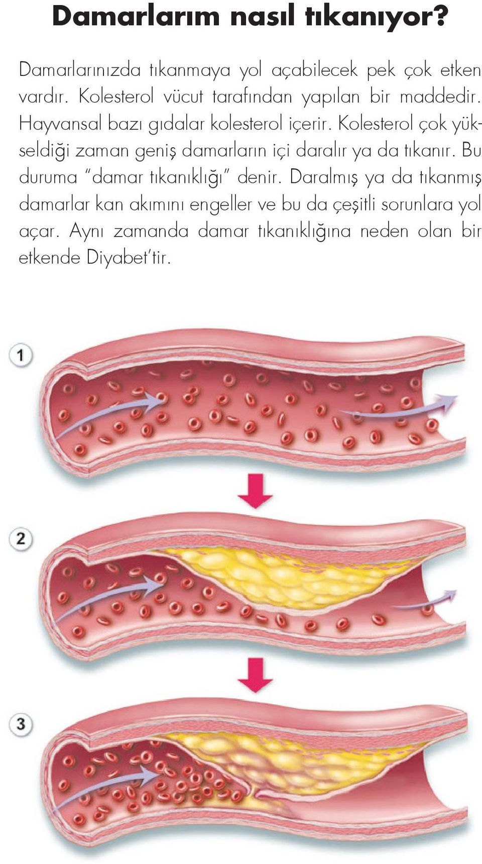 Kolesterol çok yükseldiği zaman geniş damarların içi daralır ya da tıkanır. Bu duruma damar tıkanıklığı denir.