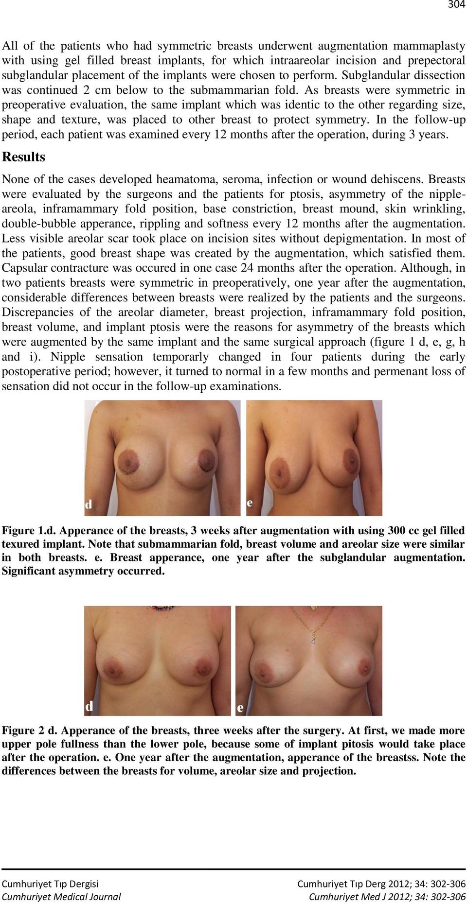As breasts were symmetric in preoperative evaluation, the same implant which was identic to the other regarding size, shape and texture, was placed to other breast to protect symmetry.