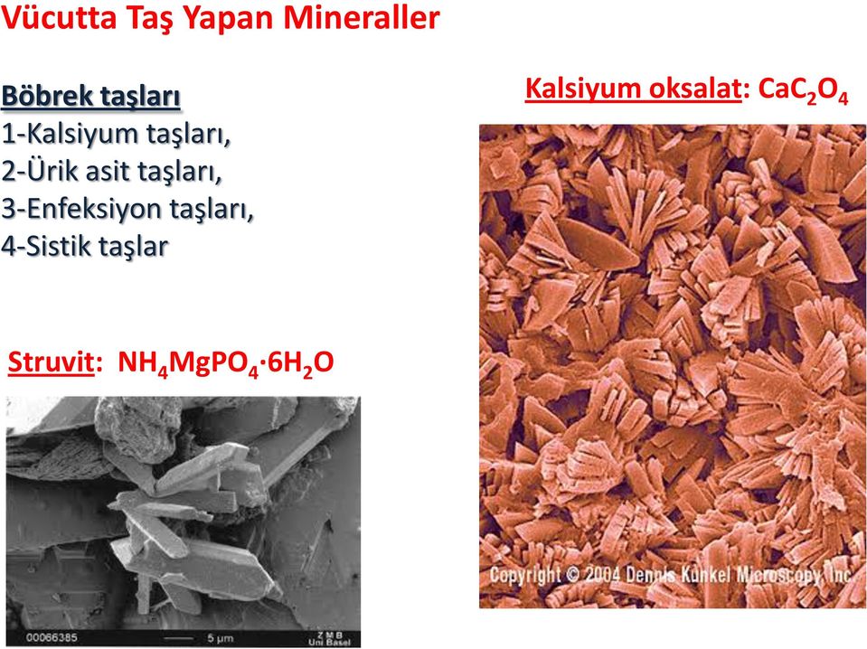 3-Enfeksiyon taşları, 4-Sistik taşlar