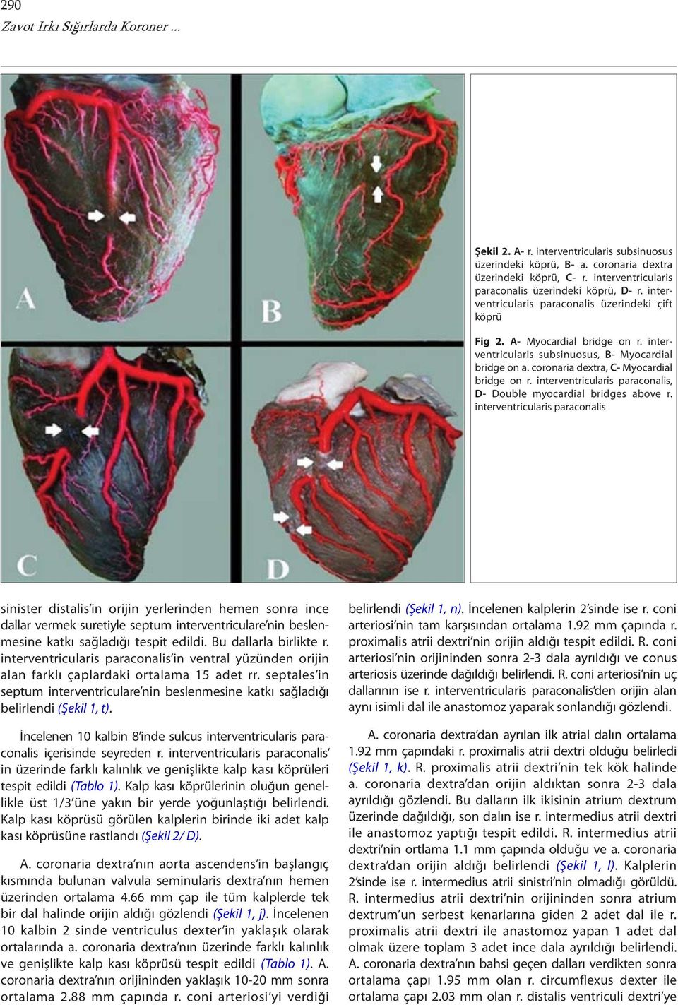 coronaria dextra, C- Myocardial bridge on r. interventricularis paraconalis, D- Double myocardial bridges above r.