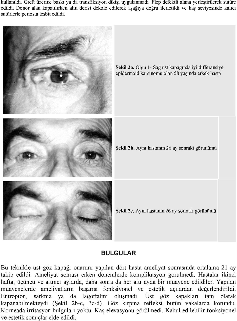 Olgu 1- Sağ üst kapağında iyi differansiye epidermoid karsinomu olan 58 yaşında erkek hasta Şekil 2b. Aynı hastanın 26 ay sonraki görünümü Şekil 2c.