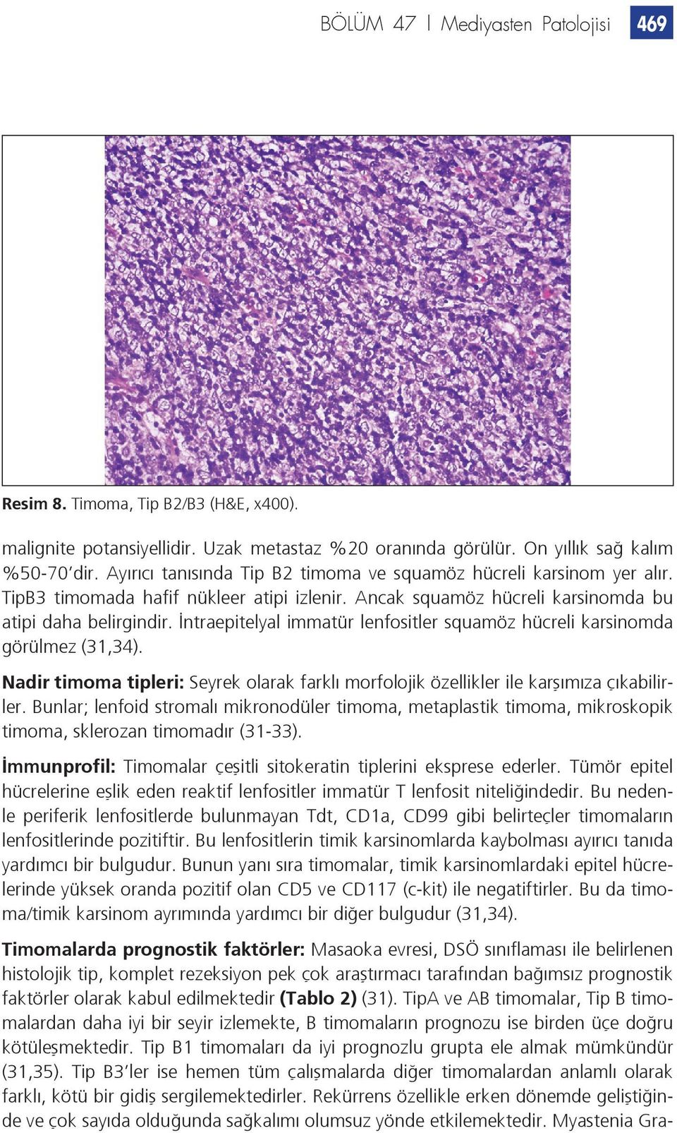 İntraepitelyal immatür lenfositler squamöz hücreli karsinomda görülmez (31,34). Nadir timoma tipleri: Seyrek olarak farklı morfolojik özellikler ile karşımıza çıkabilirler.