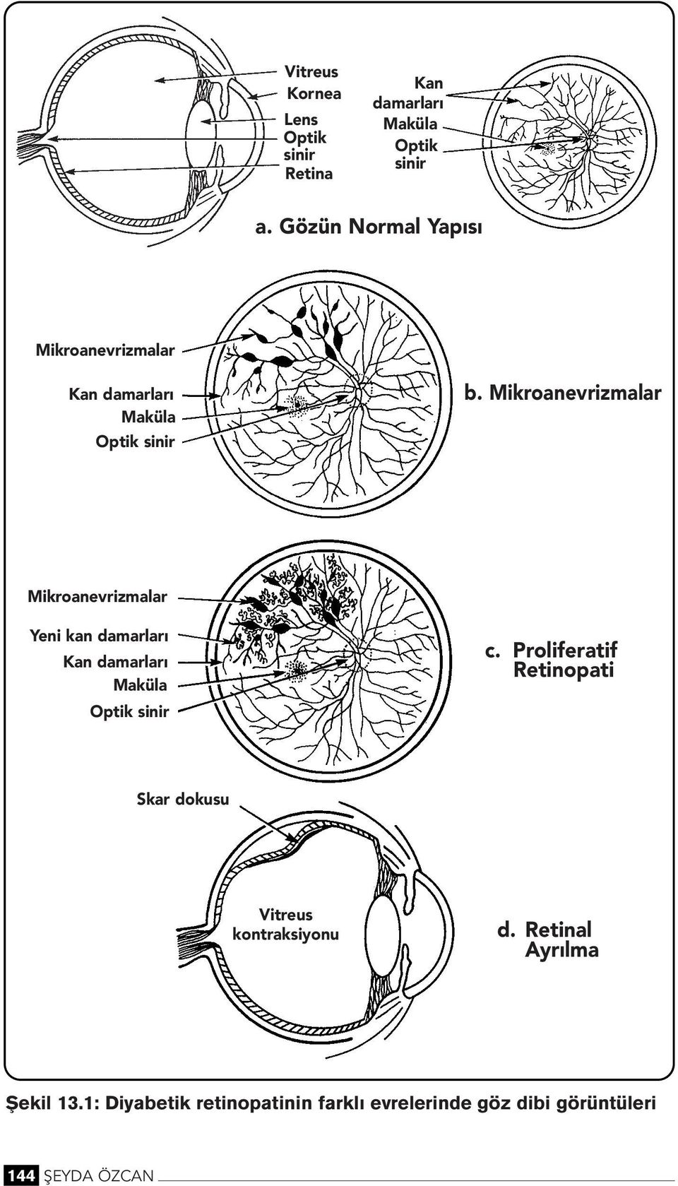 Mikroaevrizmalar Mikroaevrizmalar Yei ka damarları Ka damarları Maküla Optik siir c.