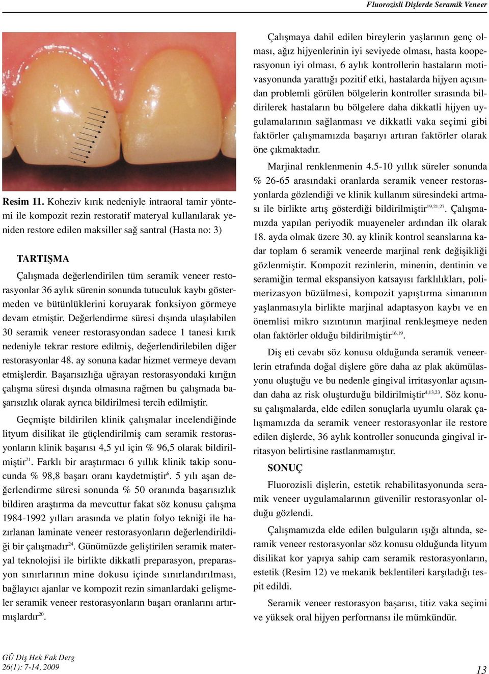 seramik veneer restorasyonlar 36 ayl k sürenin sonunda tutuculuk kayb göstermeden ve bütünlüklerini koruyarak fonksiyon görmeye devam etmifltir.