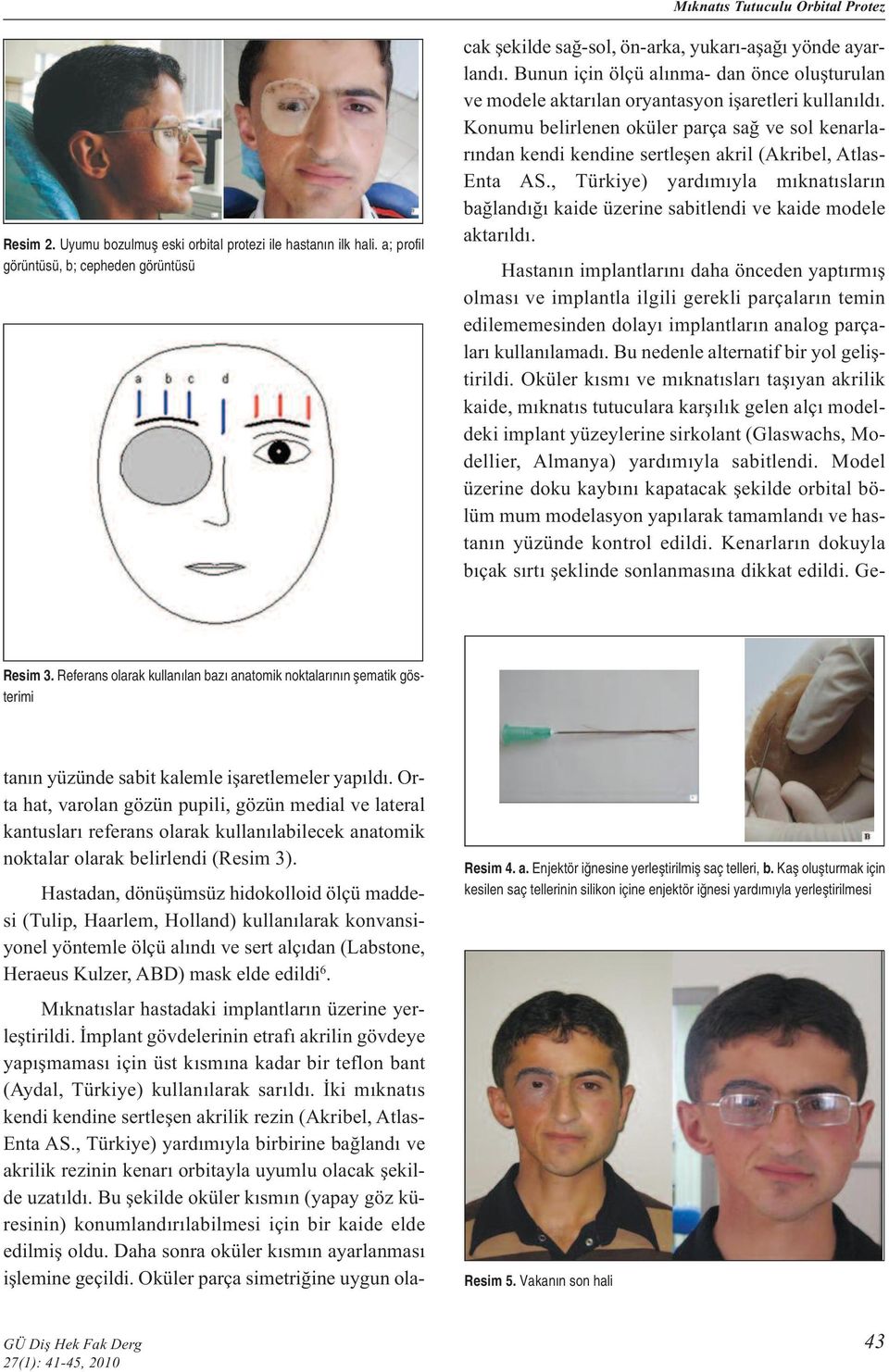 Hastadan, dönüşümsüz hidokolloid ölçü maddesi (Tulip, Haarlem, Holland) kullanılarak konvansiyonel yöntemle ölçü alındı ve sert alçıdan (Labstone, Heraeus Kulzer, ABD) mask elde edildi 6.