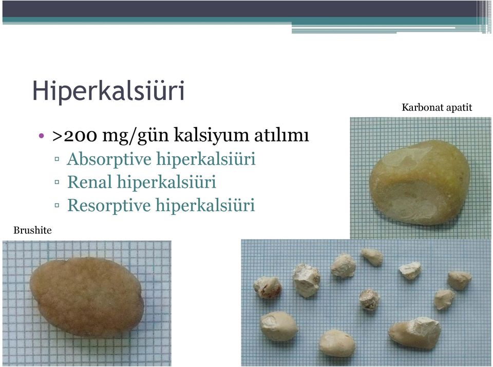 Renal hiperkalsiüri Resorptive