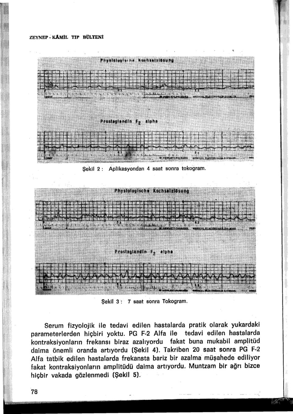 PG F 2 Alfa ile tedavi edilen hastalarda kontraksiyonlarm frekansı biraz azalıyordu fakat buna mukabil amplitüd daima önemli oranda :artıyordu