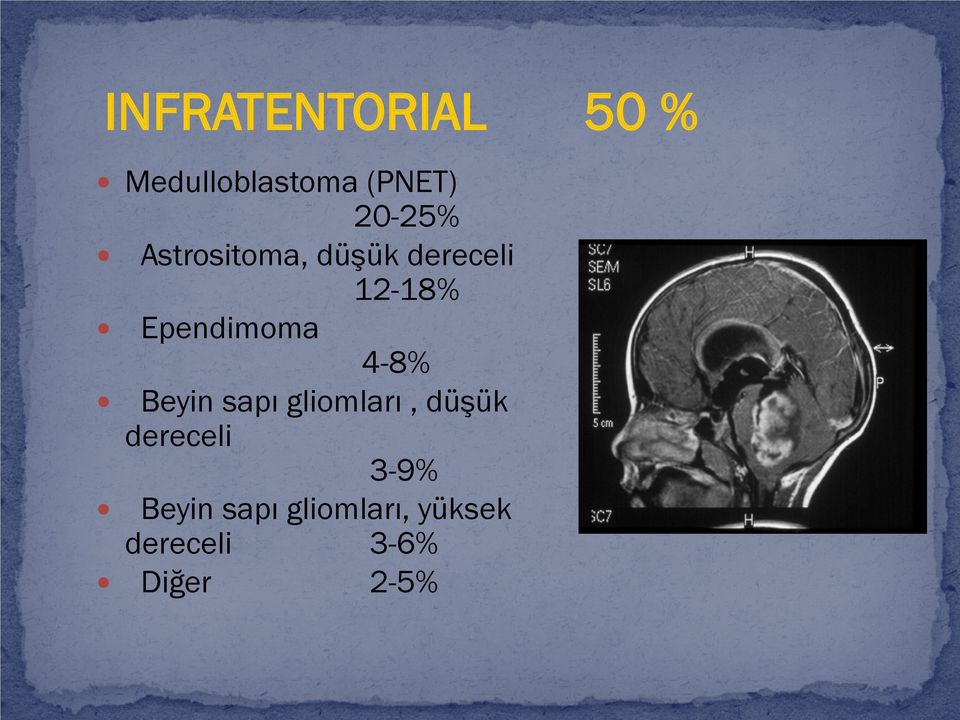 Ependimoma 4-8% Beyin sapı gliomları, düşük