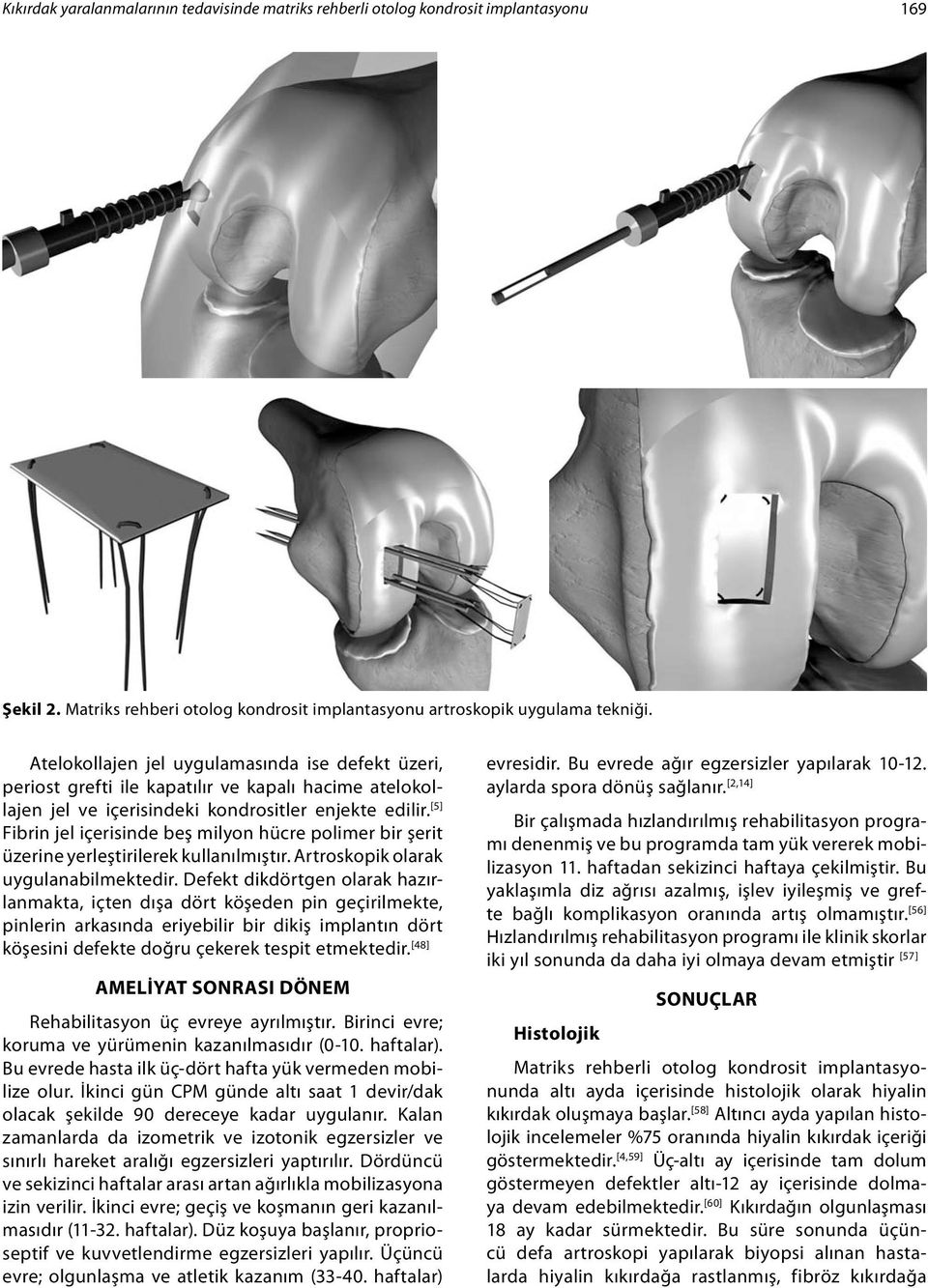 [5] Fibrin jel içerisinde beş milyon hücre polimer bir şerit üzerine yerleştirilerek kullanılmıştır. Artroskopik olarak uygulanabilmektedir.