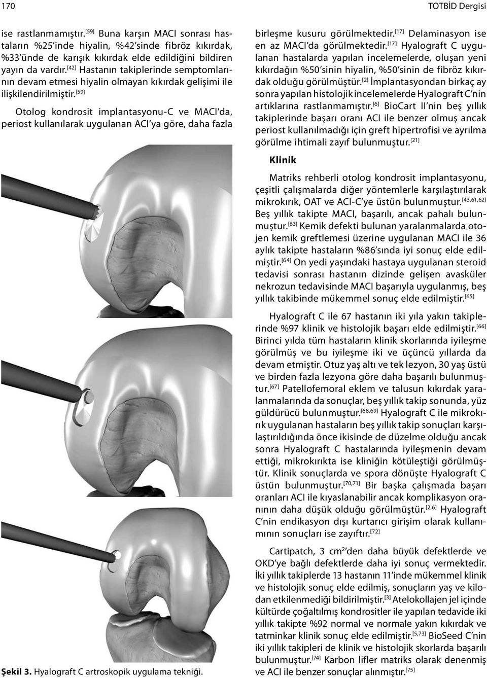 [59] Otolog kondrosit implantasyonu-c ve MACI da, periost kullanılarak uygulanan ACI ya göre, daha fazla Şekil 3. Hyalograft C artroskopik uygulama tekniği.