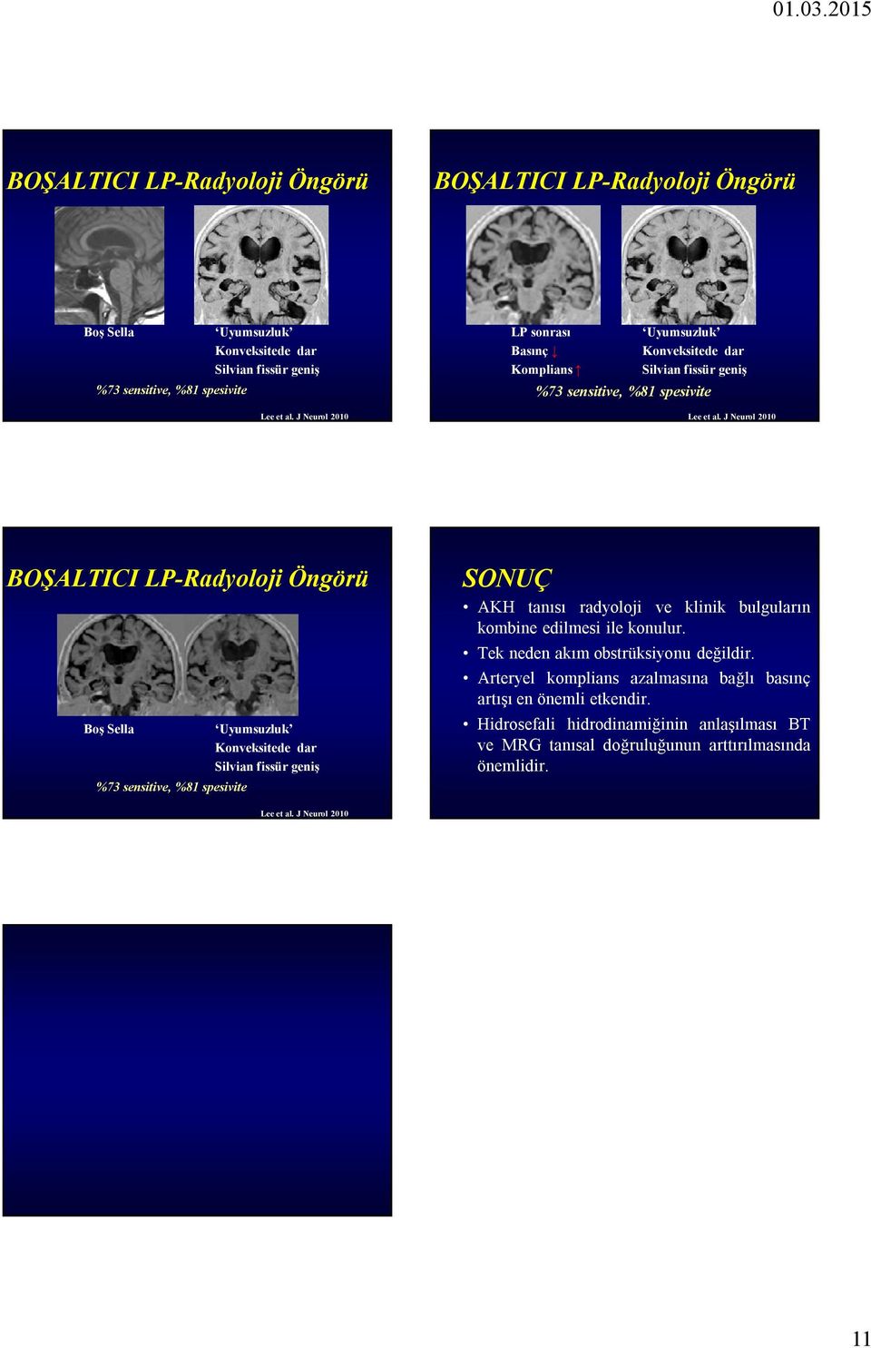 J Neurol 2010 BOŞALTICI LP-Radyoloji Öngörü Boş Sella %73 sensitive, %81 spesivite Uyumsuzluk Konveksitede dar Silvian fissür geniş SONUÇ tanısı radyoloji ve klinik bulguların