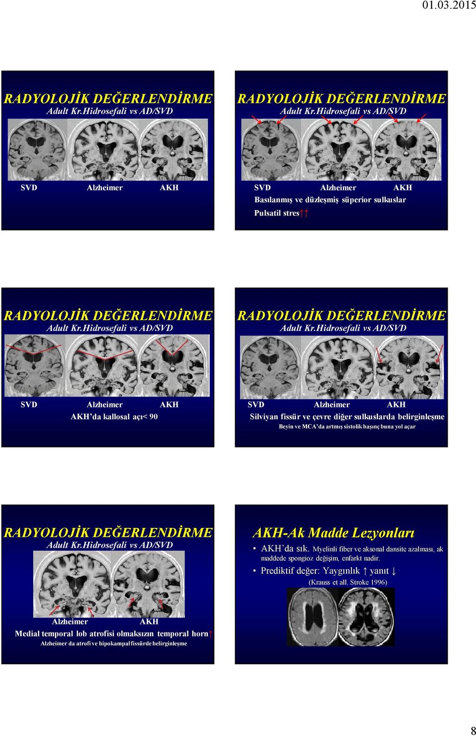 Hidrosefali vs AD/SVD SVD Alzheimer da kallosal açı 90 SVD Alzheimer Silviyan fissür ve çevre diğer sulkuslarda belirginleşme Beyin ve MCA da artmış sistolik başınç buna yol