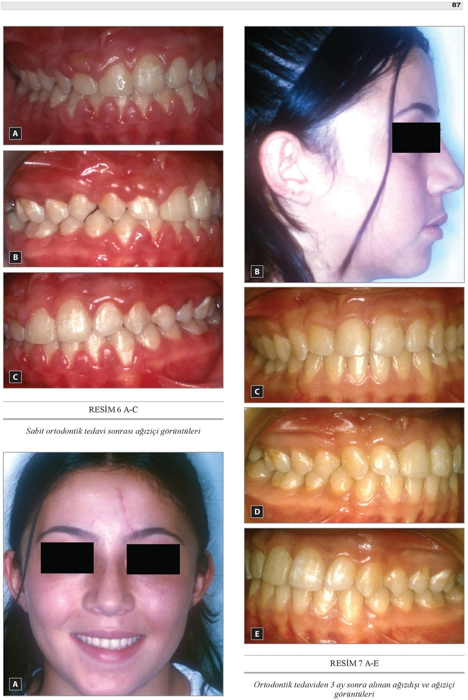 7 -E Ortodontik tedaviden 3 ay sonra