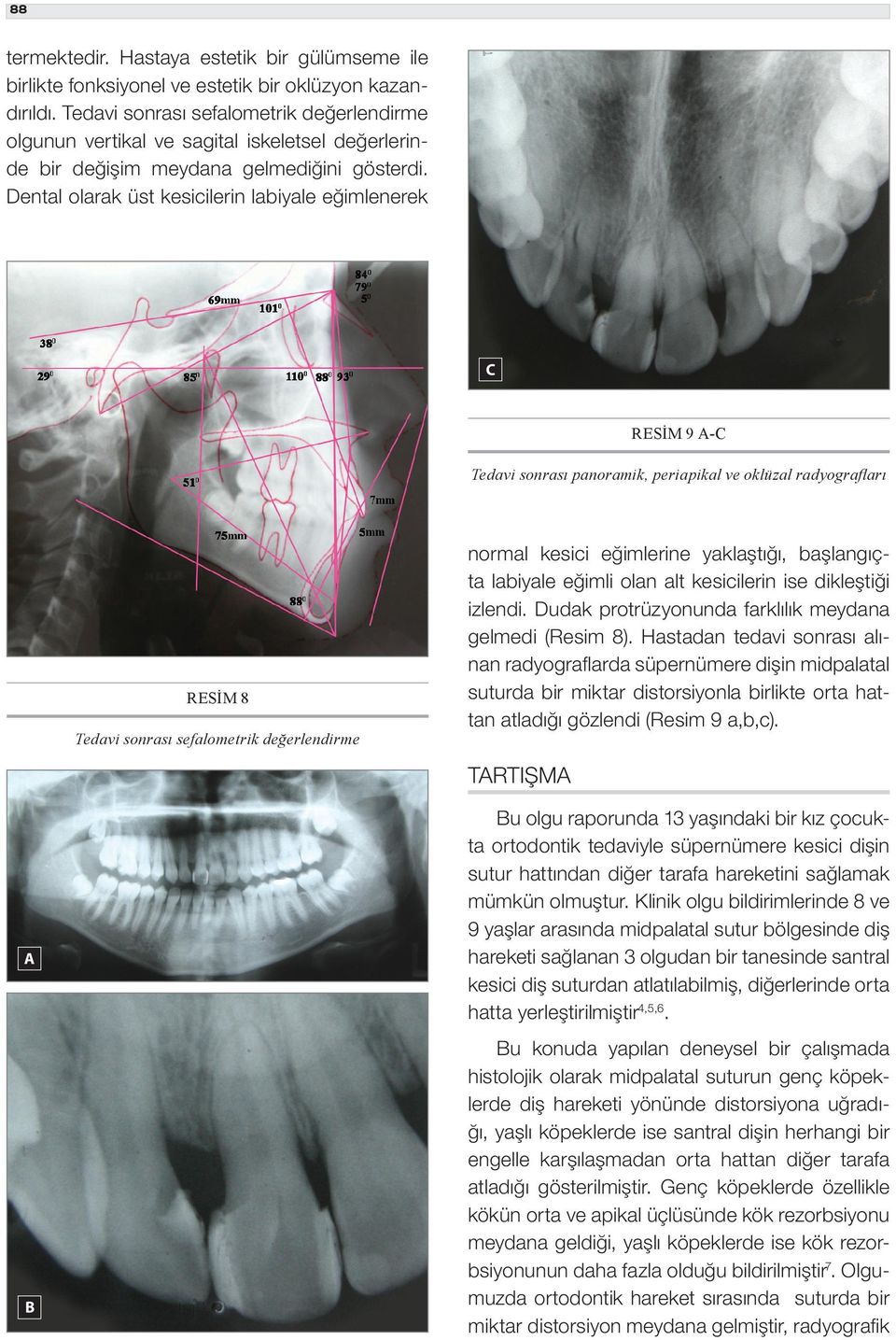 Dental olarak üst kesicilerin labiyale eğimlenerek RESİM 9 - Tedavi sonrası panoramik, periapikal ve oklüzal radyografları RESİM 8 Tedavi sonrası sefalometrik değerlendirme normal kesici eğimlerine